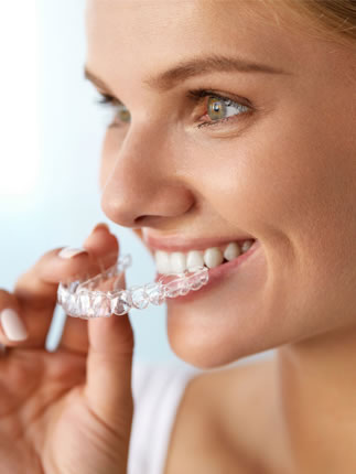 clear aligners
