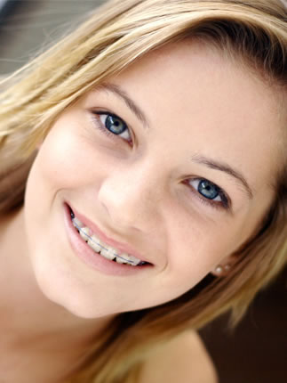 clear braces