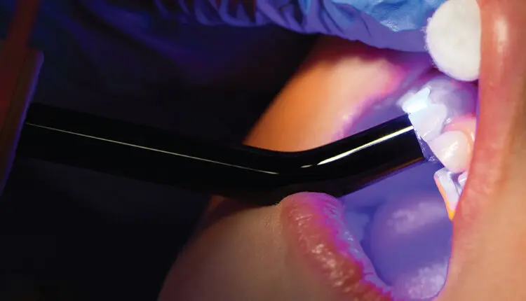 Why Choose Dental Sealants for Kids in Wellesley, MA