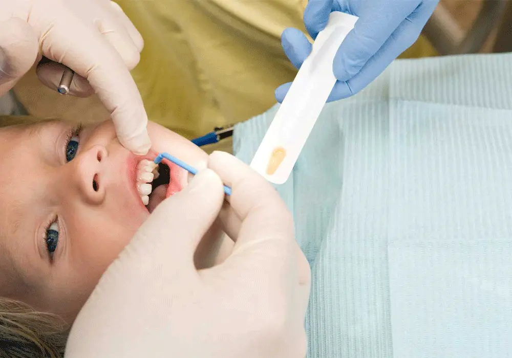 Why Choose Silver Diamine Fluoride for Kids in Wellesley, MA