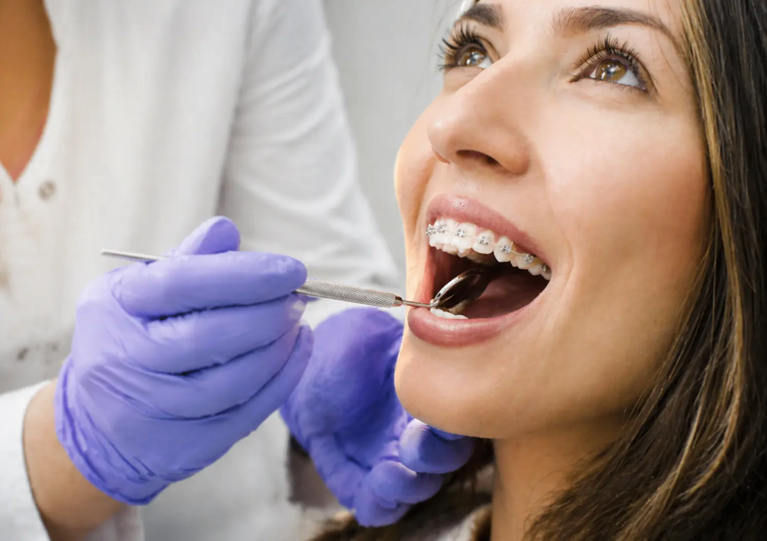 Why Should I Choose Adult Braces