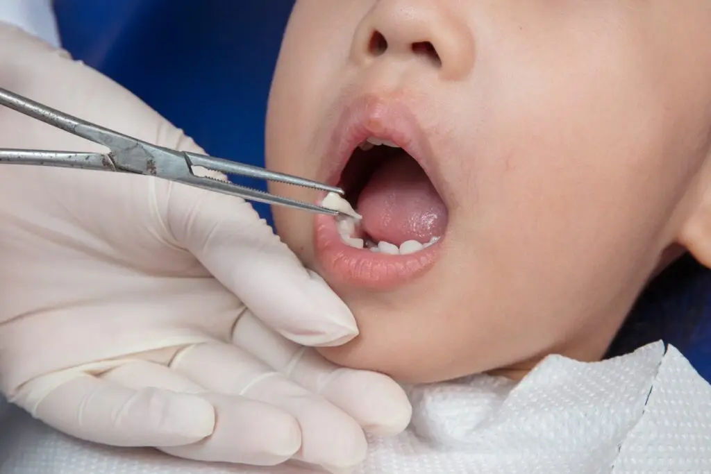 Why Should I Choose Pediatric Tooth Extraction